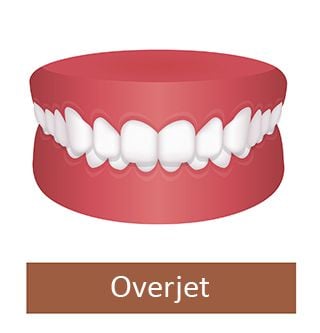 overjet