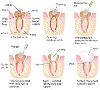 root canal treatment